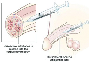 Erectile Dysfunction Treatment Options